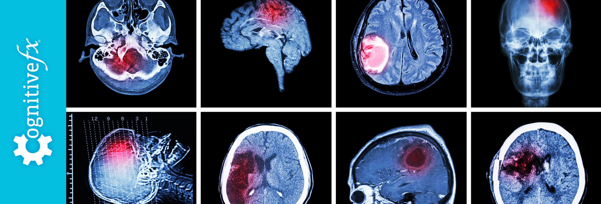 Differences Between PostConcussion Syndrome (PCS) & Chronic Trauma